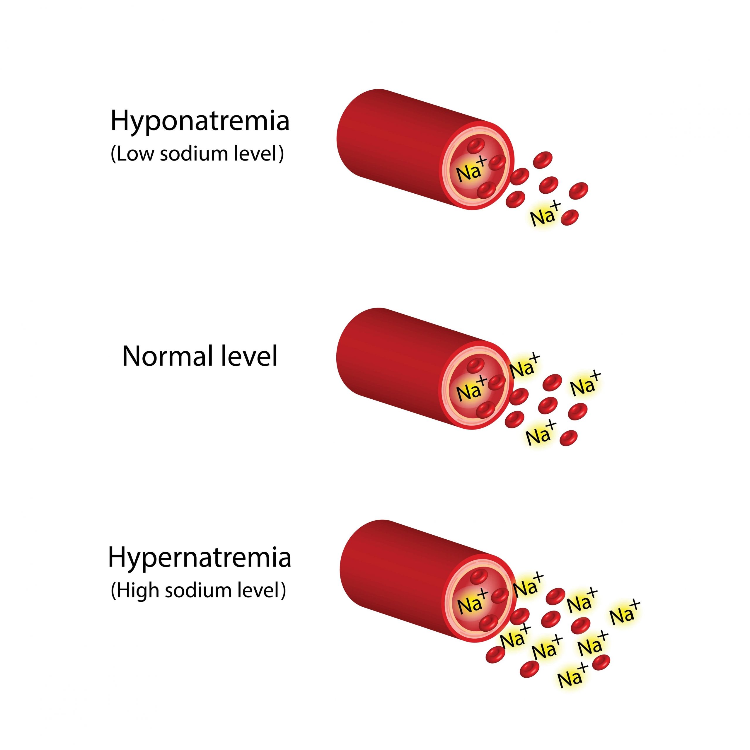 Approach to Hypernatremia