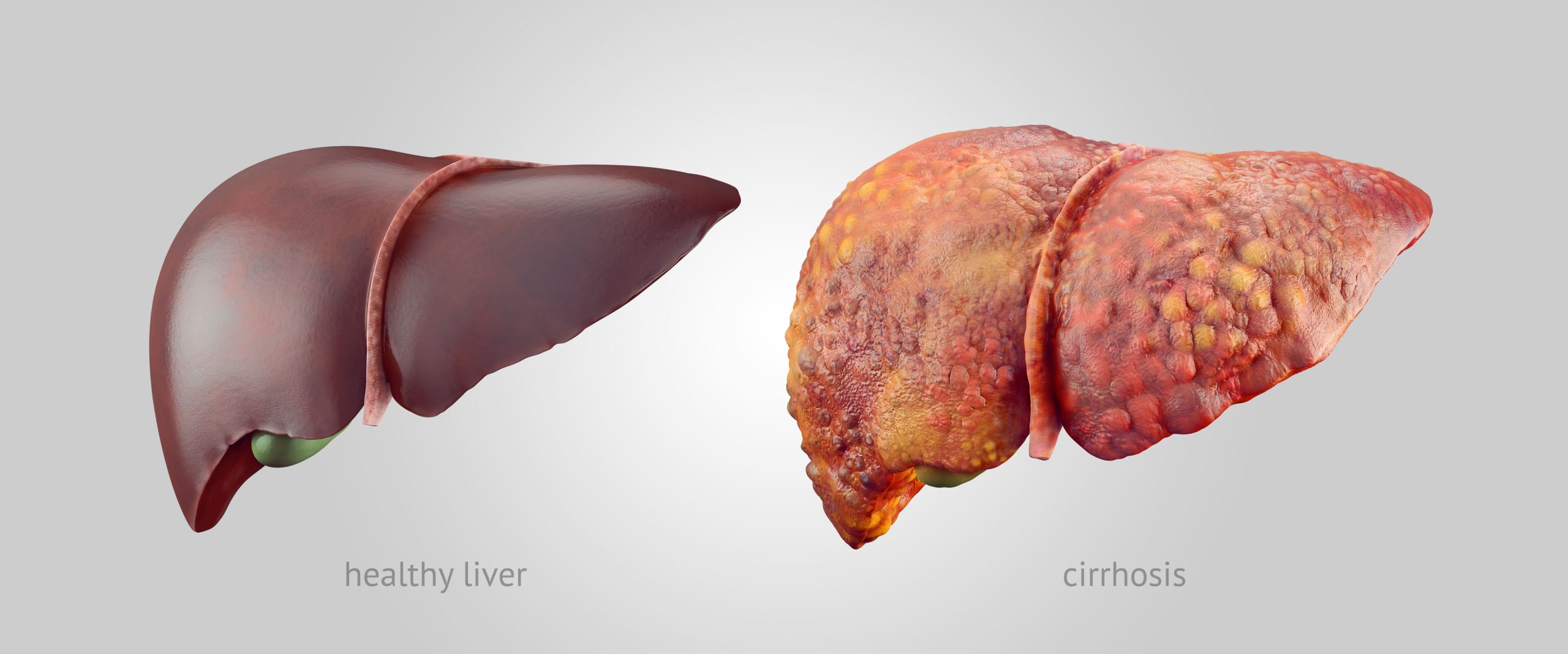 Cirrhosis