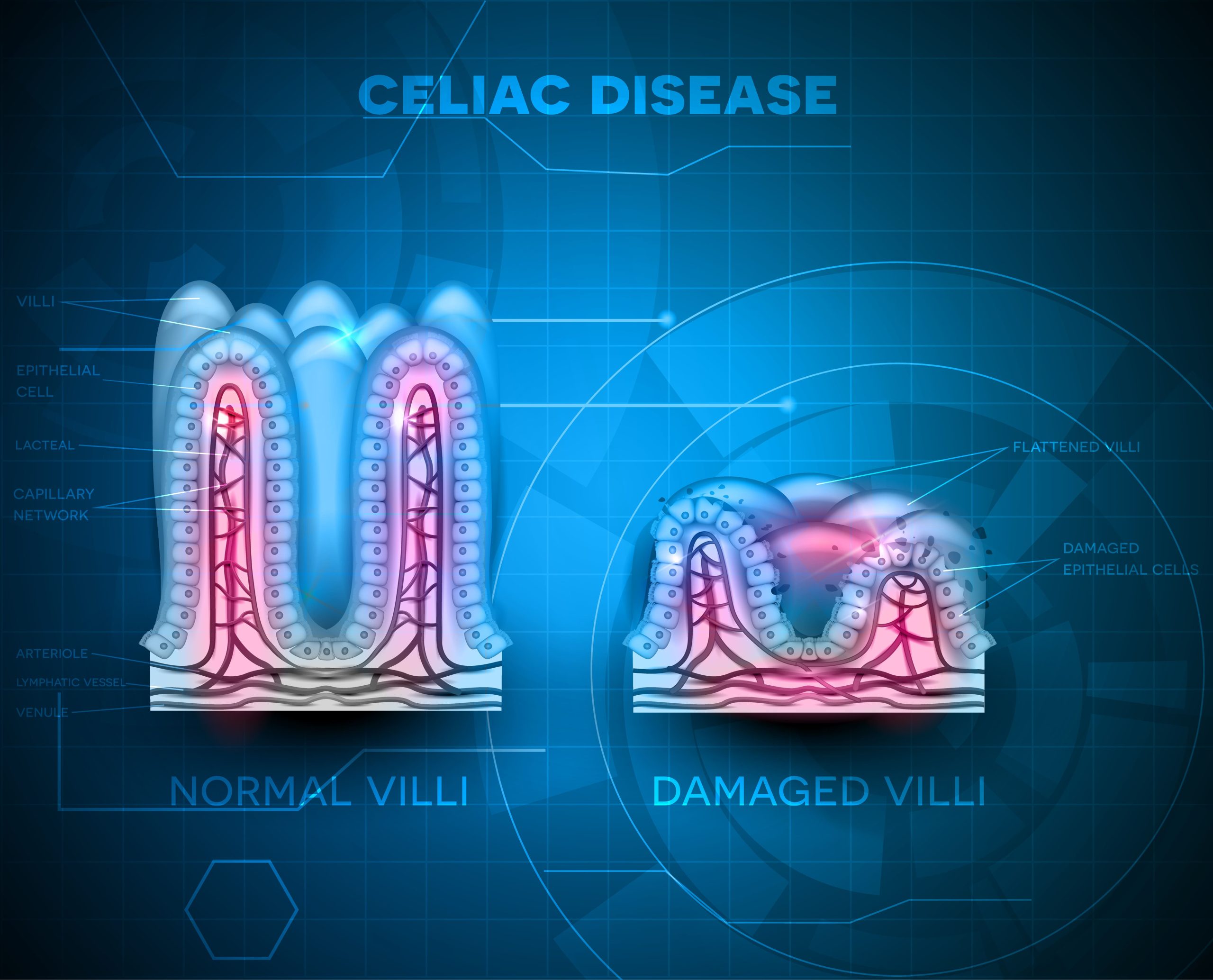 Celiac disease