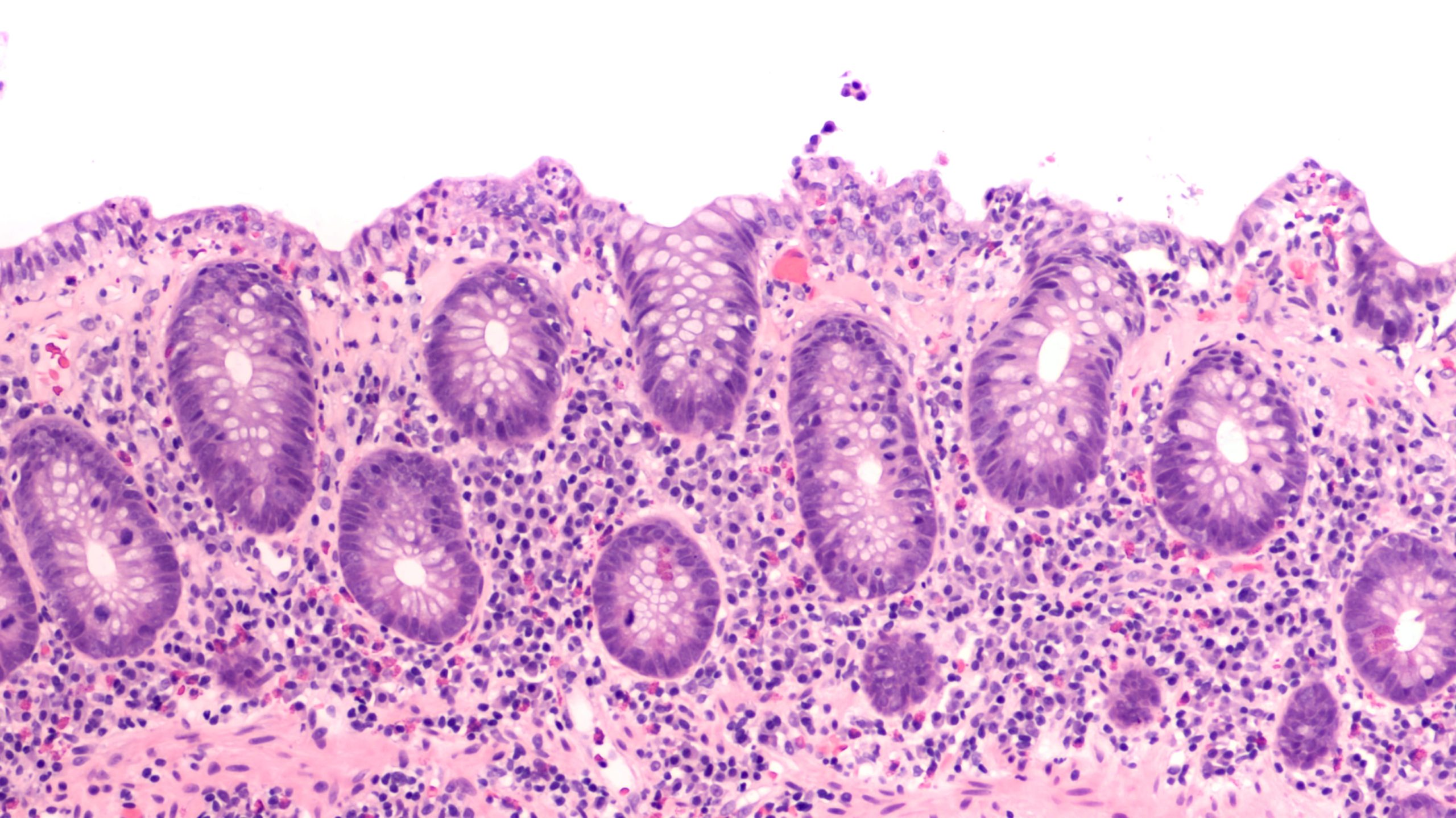 Microscopic Colitis