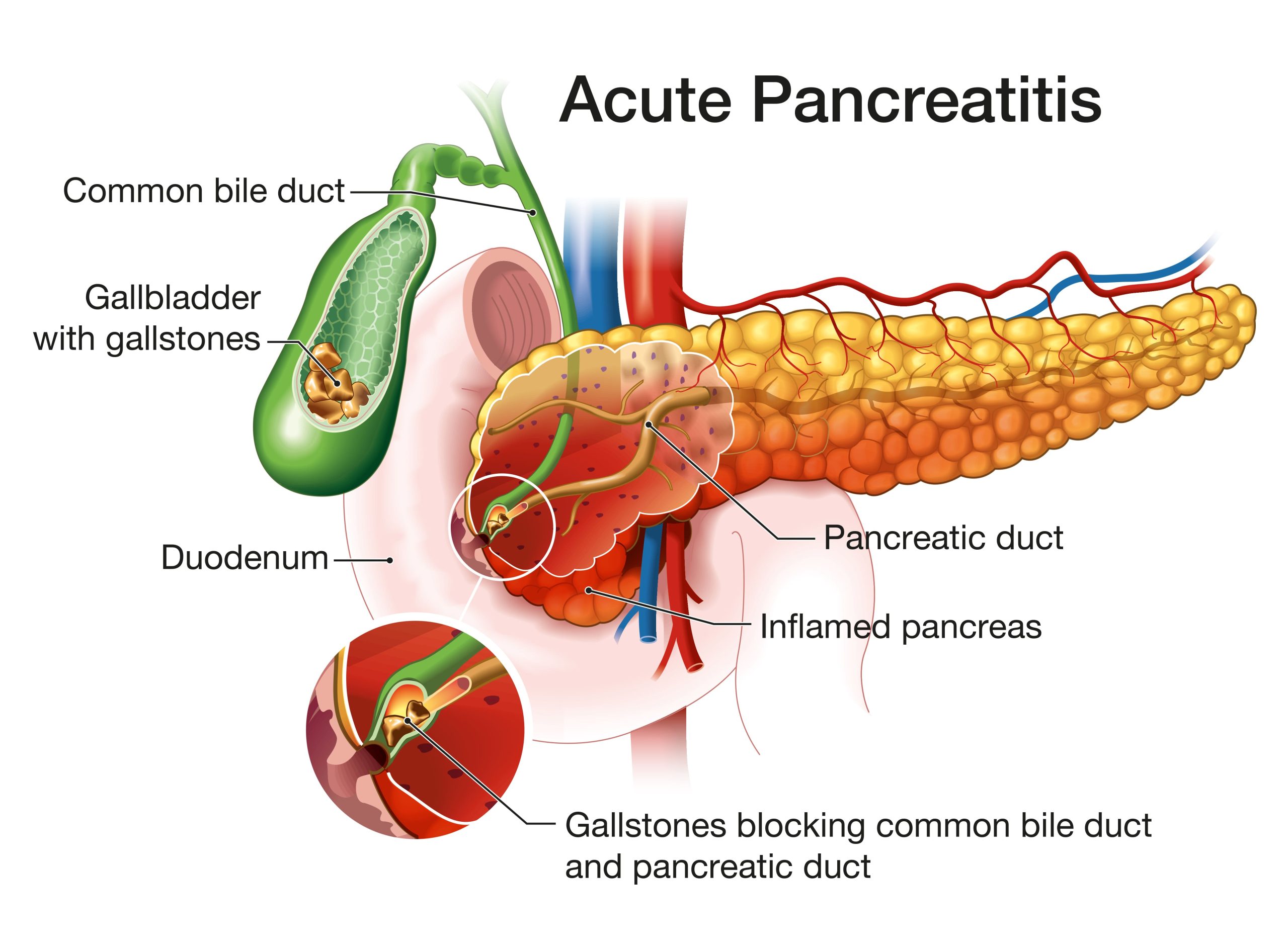 Pancreatitis